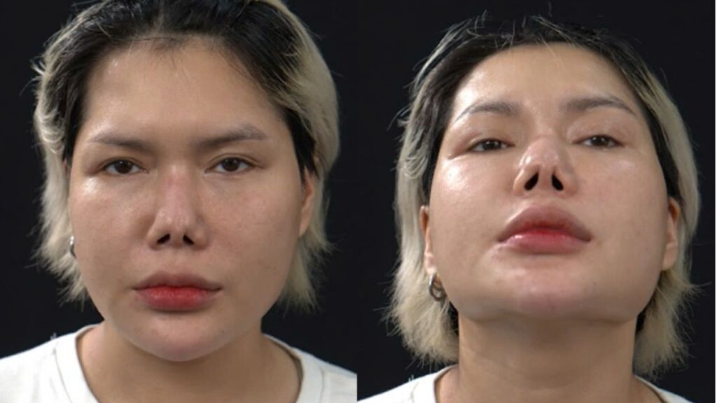 Nâng mũi bị co rút (mũi ngắn lại, hếch lên) thì sửa được không?