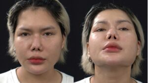 Nâng mũi bị co rút (mũi ngắn lại, hếch lên) thì sửa được không?
