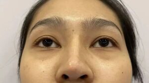 Nâng mũi xong bị lệch thì có tự hết trong thời gian sưng không?