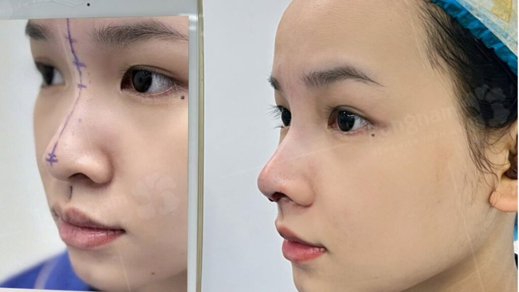 Nâng mũi cấu trúc giá bao nhiêu tiền ở Hà Nội?