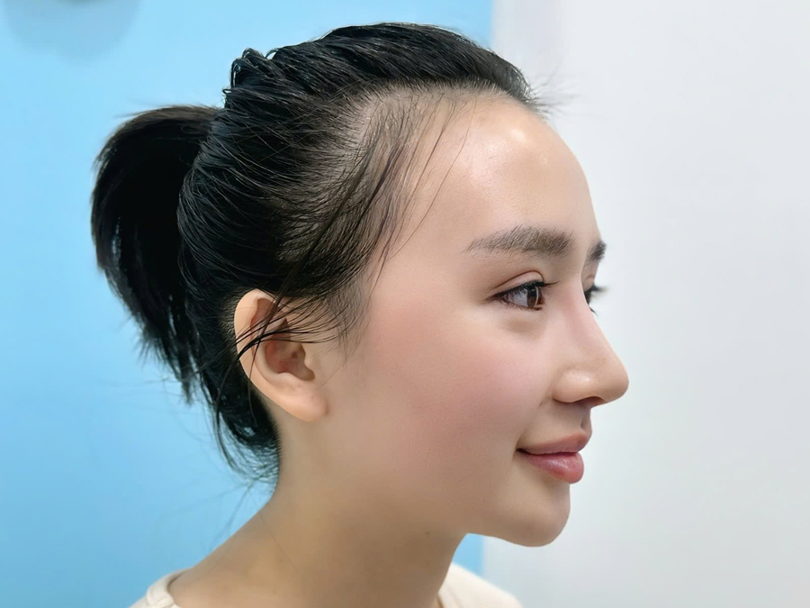 Dáng mũi cấu trúc L line