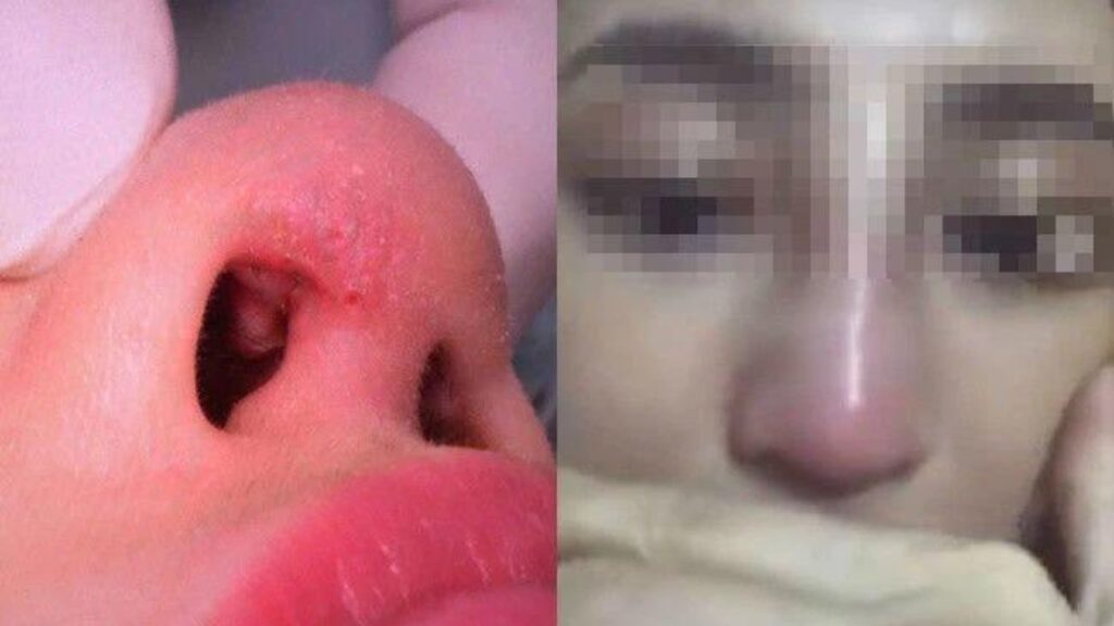 Nâng mũi bị nhiễm trùng có dấu hiệu gì, bao lâu sau mổ thì hay xảy ra?
