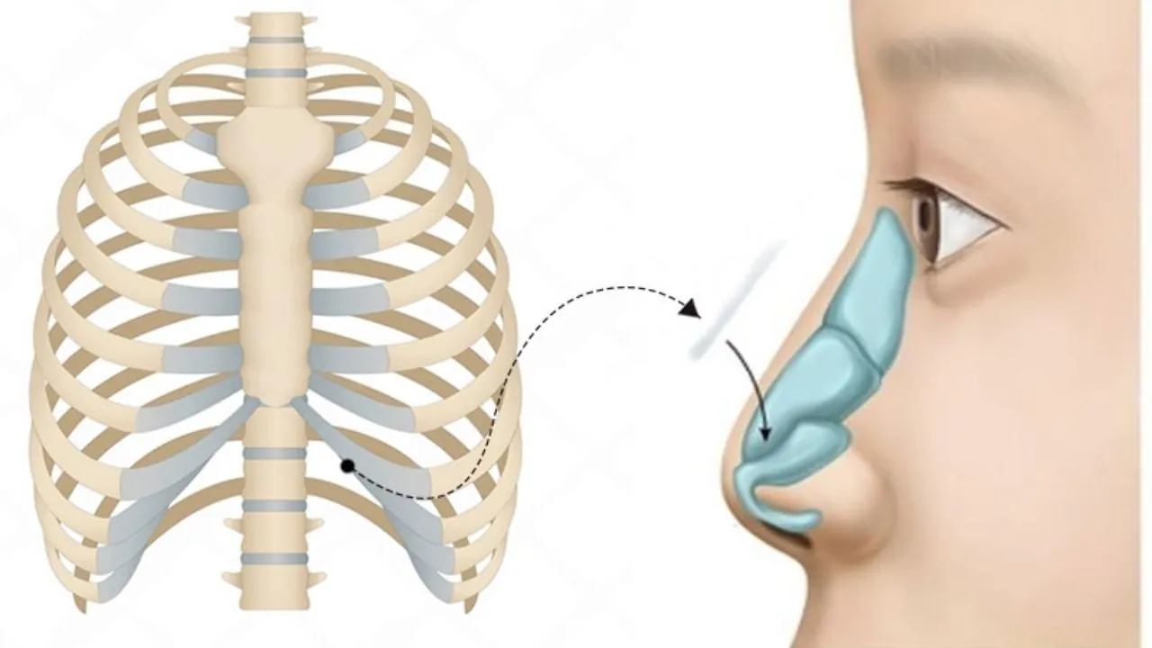 Sử dụng sụn sườn để làm trụ mũi và đầu mũi khắc phục tình trạng đào thải, bóng đỏ