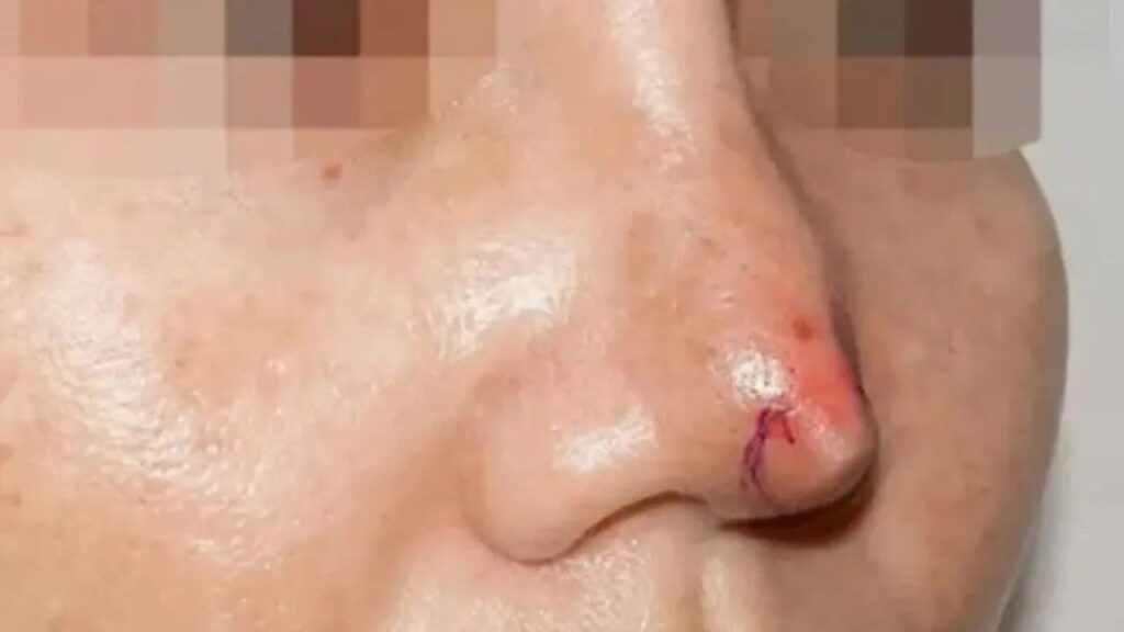 Nâng mũi bị tụt sụn thì phải làm sao? Có cần phải tháo sụn không