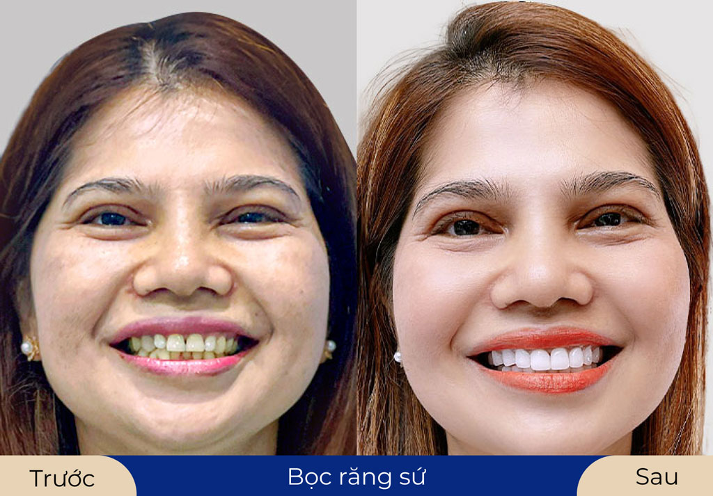Khách răng xỉn, vàng sau khi bọc sứ tại Kangnam tự tin với nụ cười tươi sáng