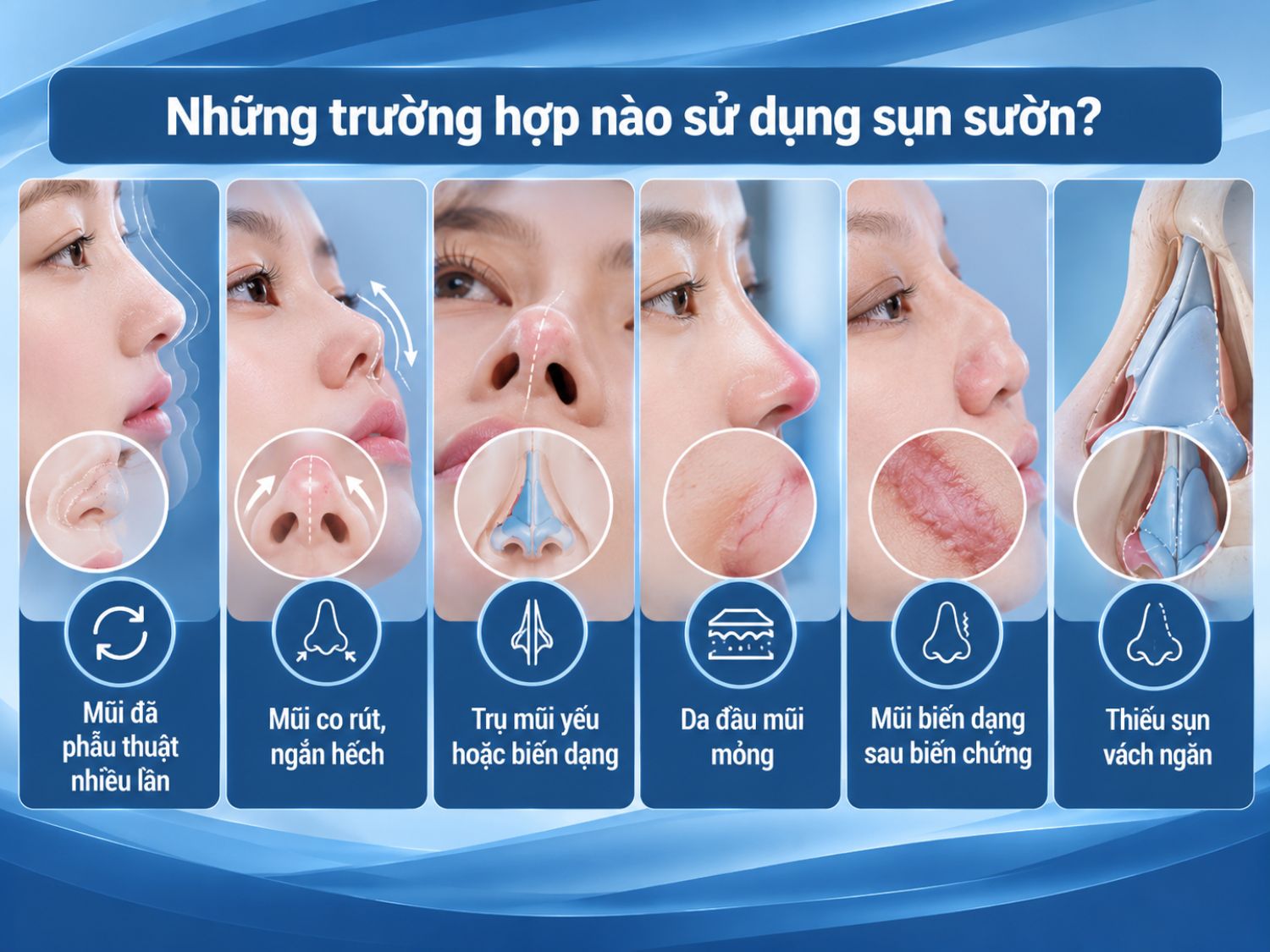 Sụn sườn có thể được cân nhắc khi mũi đã phẫu thuật nhiều lần, co rút, biến dạng, trụ mũi yếu hoặc không còn đủ sụn tự thân tại vách ngăn.