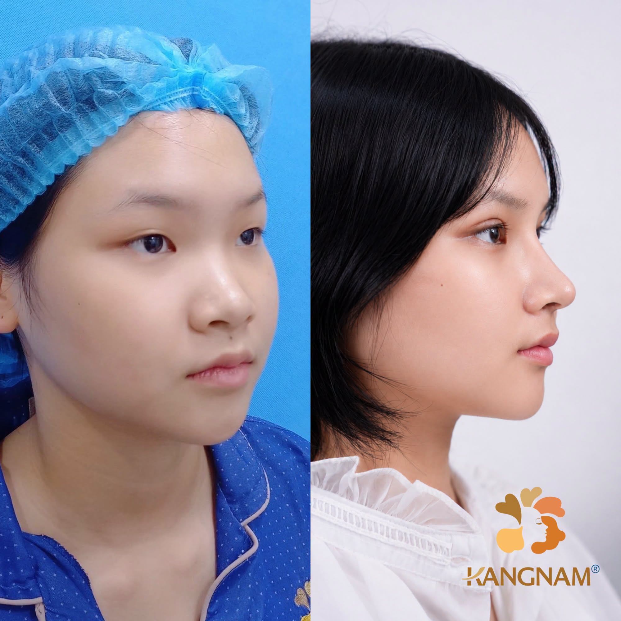 Lựa chọn kỹ thuật nâng mũi phù hợp giúp khách hàng sở hữu dáng mũi cân đối, tự nhiên