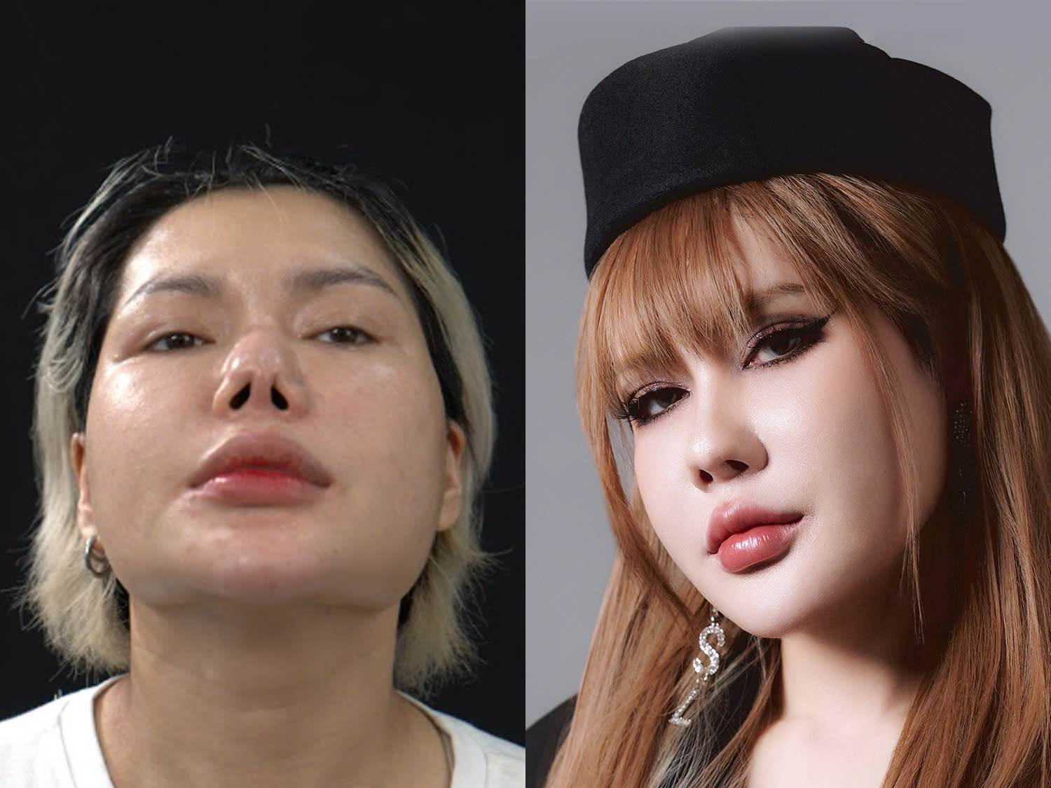 Quỳnh Mai đã được sửa mũi tại Kangnam giúp dáng mũi cân đối, hài hòa hơn