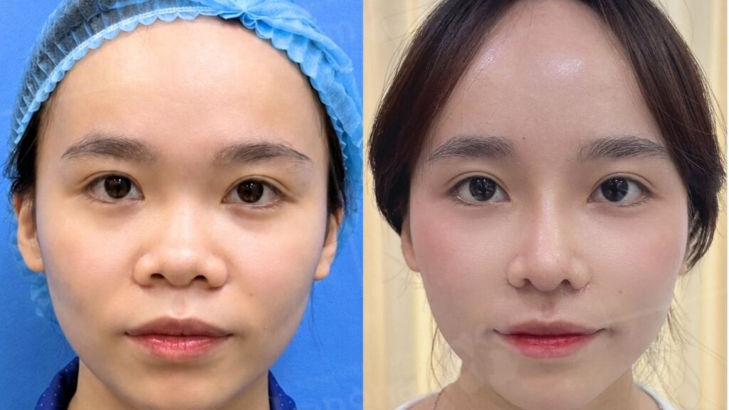 Review nâng mũi ở Kangnam có thật không?