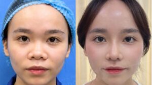 Review nâng mũi ở Kangnam có thật không?