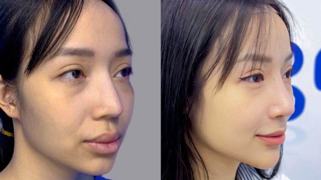 Sửa mũi hỏng lần 2, lần 3 có được không, có giới hạn số lần không?