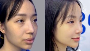 Sửa mũi hỏng lần 2, lần 3 có được không, có giới hạn số lần không?