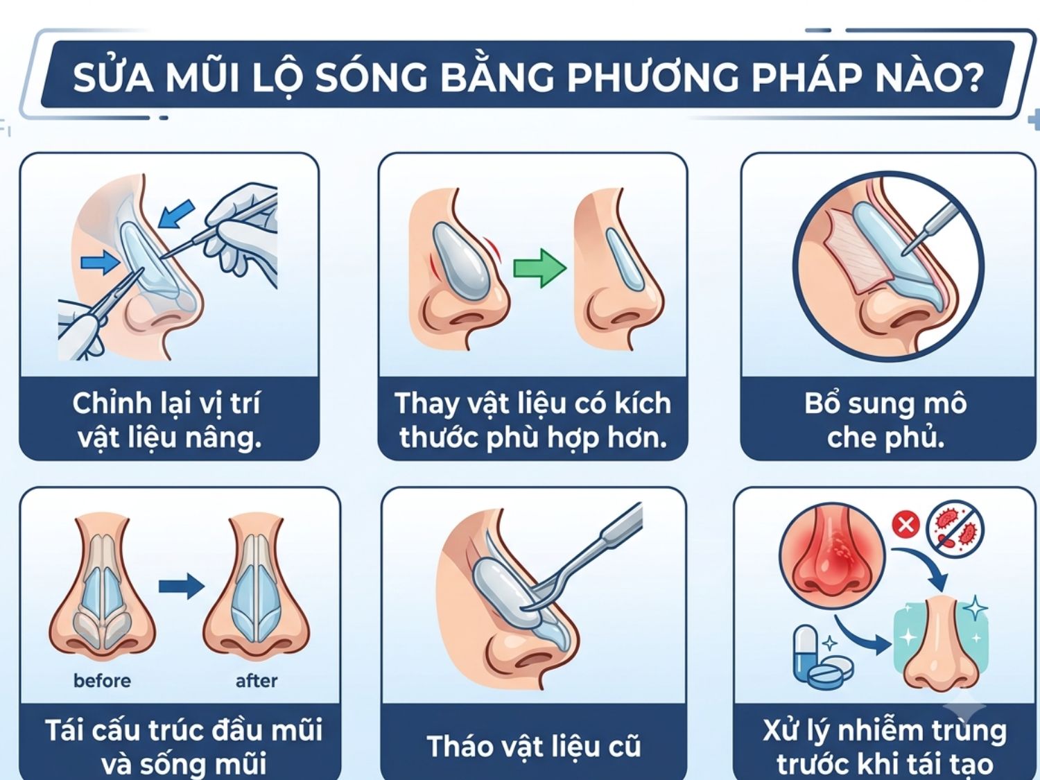 Tùy thuộc vào nguyên nhân và mức độ lộ sóng mũi, bác sĩ sẽ chỉ định phương pháp xử lý phù hợp như: chỉnh lại vị trí/thay thế vật liệu nâng, bọc thêm mô che phủ, tái cấu trúc mũi hoặc điều trị triệt để nhiễm trùng trước khi thực hiện tái tạo.