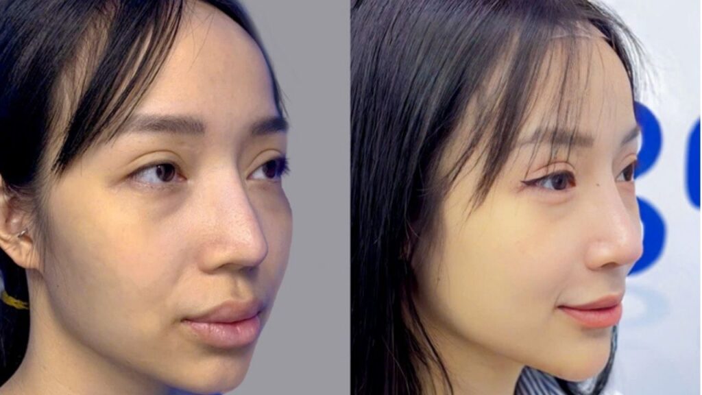 Mũi nâng đã 5 năm giờ bị cứng và lệch dần thì có phải làm lại không?