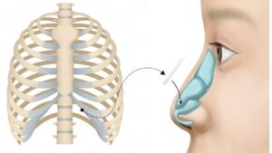 Sửa mũi hỏng cần dùng sụn sườn hay sụn tai là đủ?