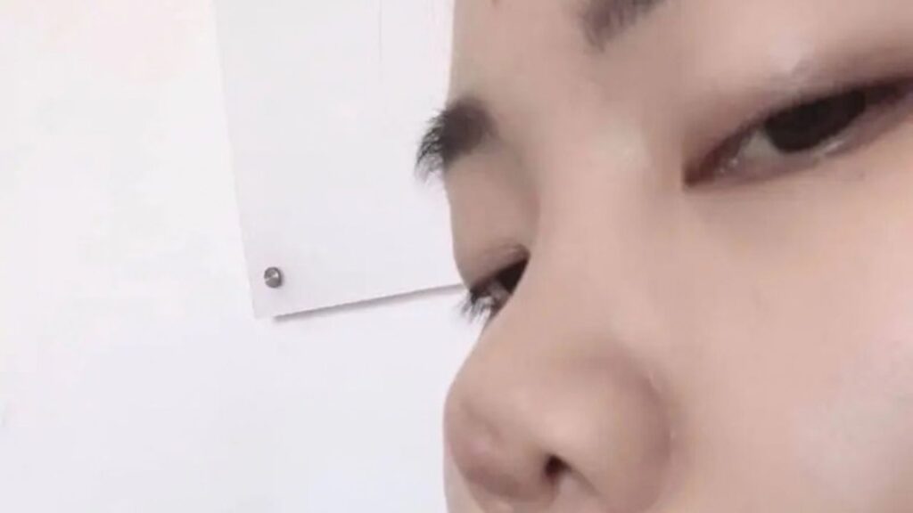 Tháo sụn mũi ra thì mũi có về được như ban đầu không?