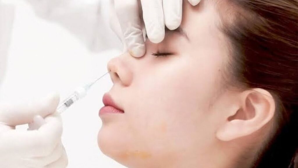 Filler mũi tiêm ở spa bị hoại tử thì cấp cứu ở đâu?