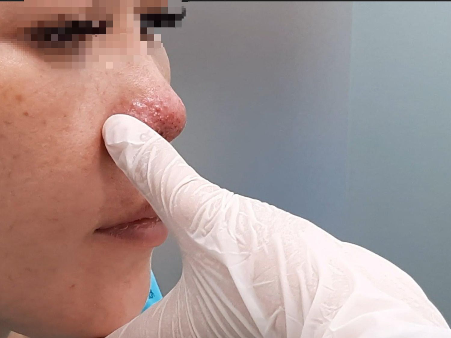 Bất thường ở da vùng mũi sau tiêm filler cần được đánh giá sớm để phát hiện tắc mạch, thiếu máu mô và nguy cơ hoại tử.