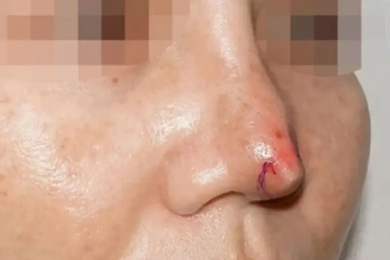 Da đầu mũi mỏng nguy hiểm khi tụt sụn mũi