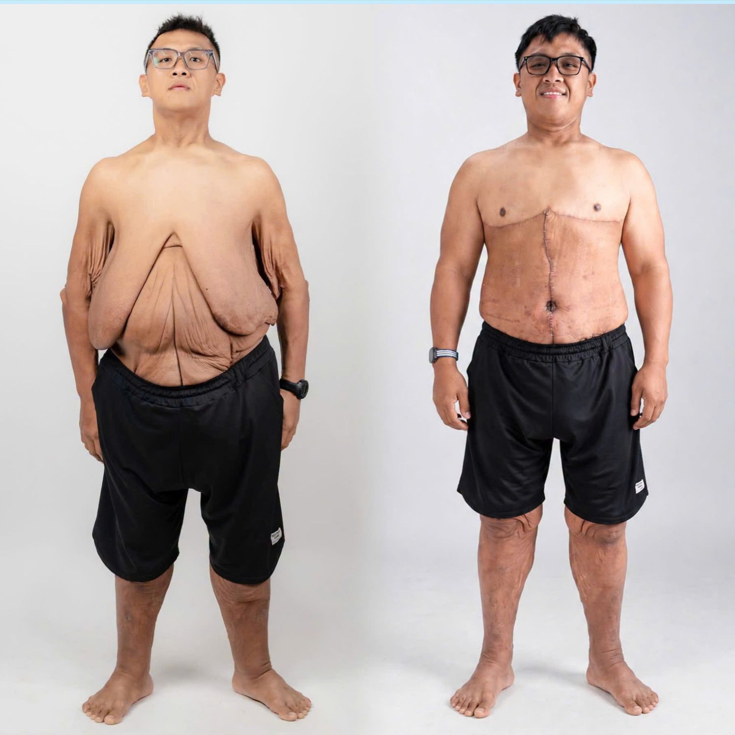 Ảnh so sánh trước và sau khi cắt da thừa, Trọng Nhân sở hữu cơ thể nhẹ nhàng, cân đối