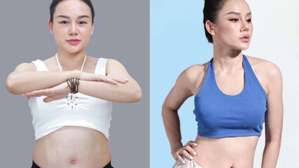 Mommy Makeover giá bao nhiêu? Nâng ngực kết hợp hút mỡ bụng hết bao nhiêu tiền?