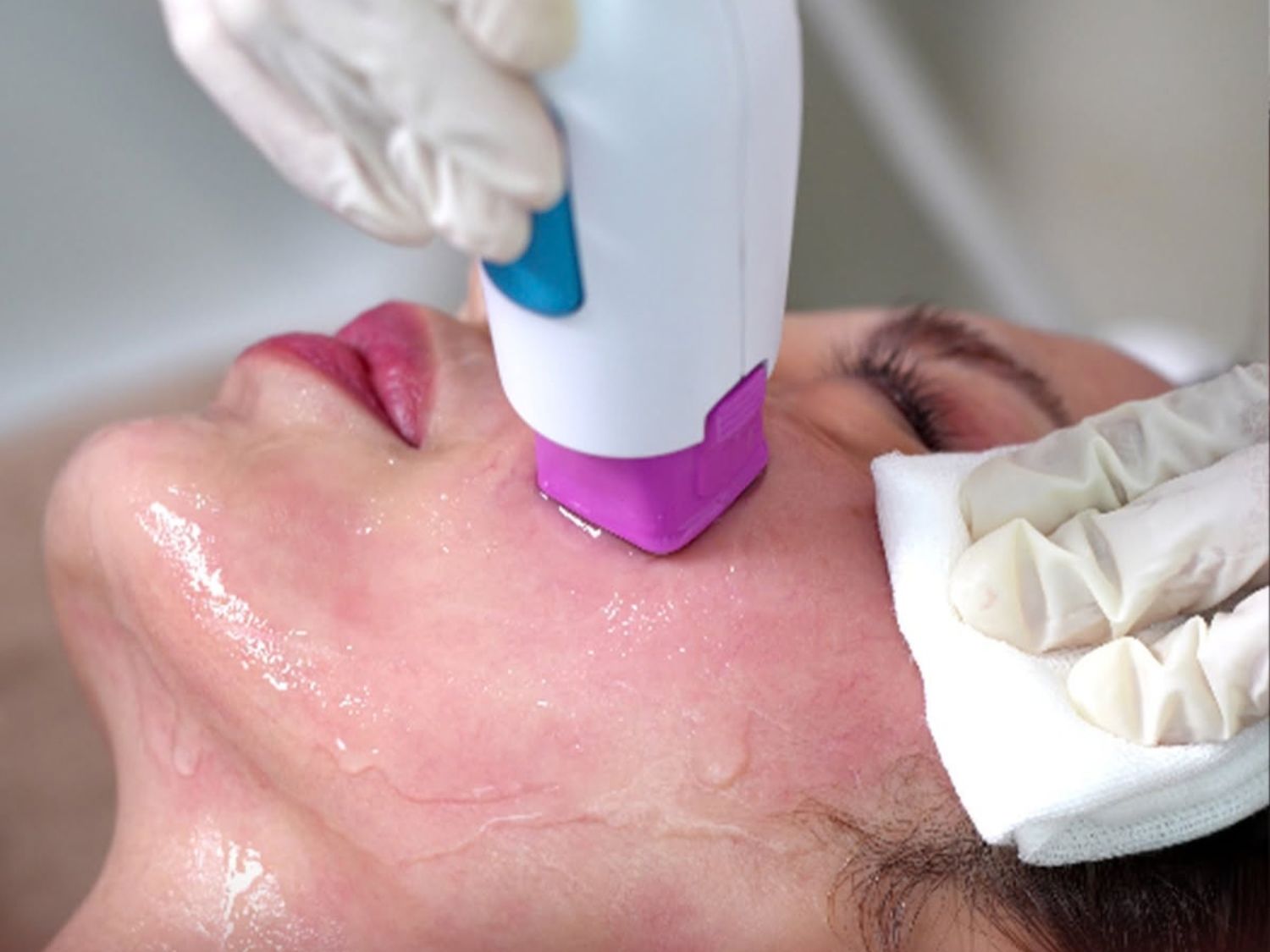 Đầu điều trị Thermage FLX tiếp xúc trực tiếp với da, truyền năng lượng RF nhằm hỗ trợ cải thiện độ săn chắc và tình trạng da chùng.