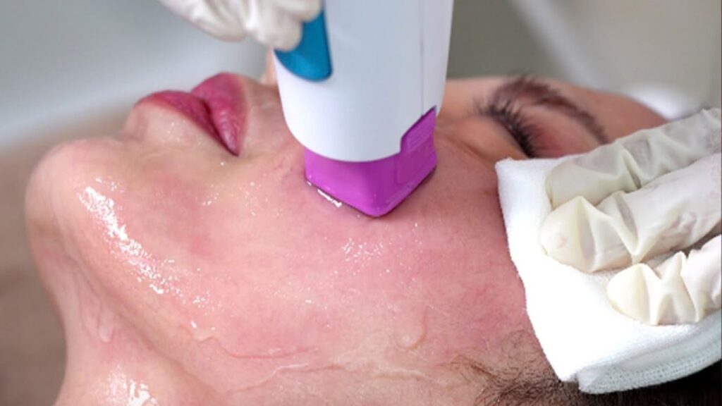 Thermage FLX ở Kangnam có phải máy chuyển giao chính hãng không, khác gì máy RF thường?