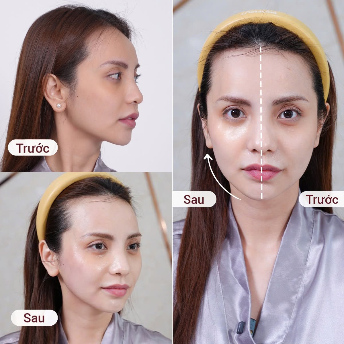 Diễn viên, Mc Bùi Linh Chi sau khi thực hiện trẻ hóa da bằng công nghệ Thermage, tiêm Profhilo và Linerase