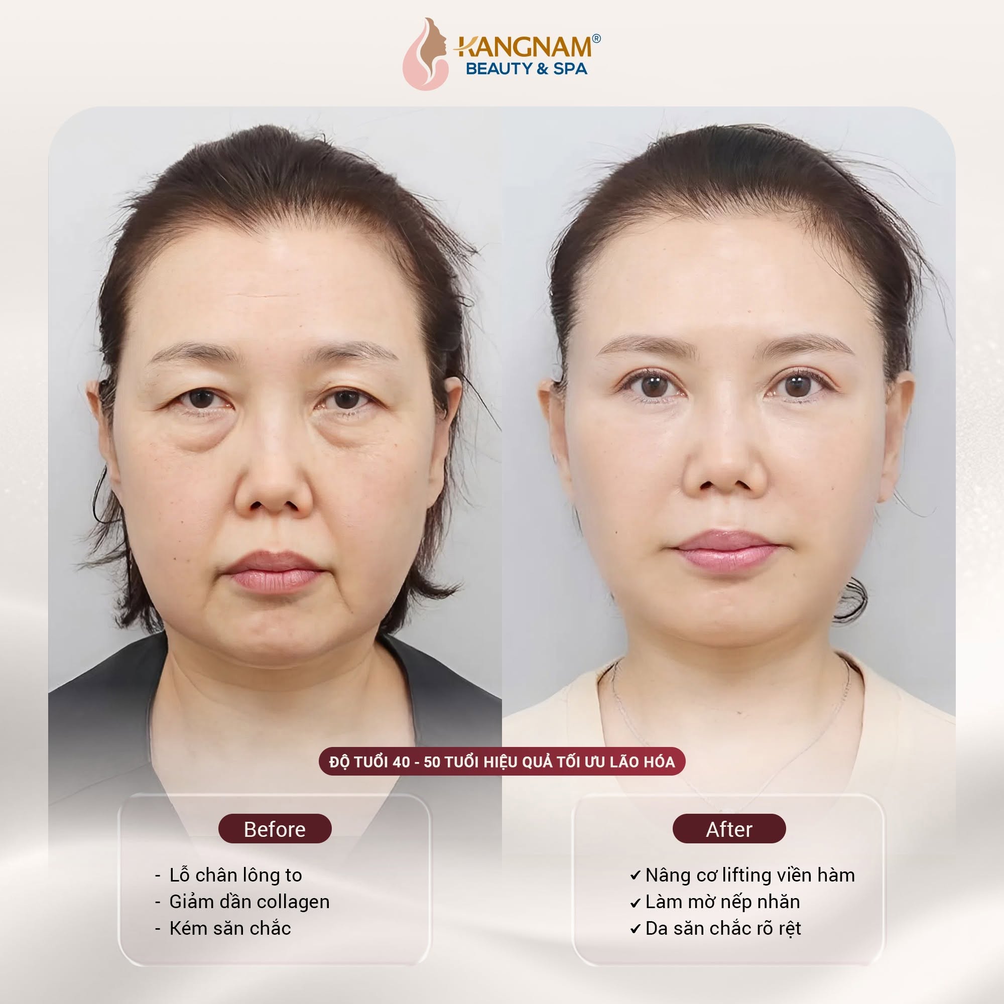 Ở nhóm có dấu hiệu lão hóa rõ hơn, Ultherapy PRIME hướng đến cải thiện tình trạng da kém săn chắc, nếp nhăn và đường nét khuôn mặt. Hiệu quả thực tế tùy tình trạng mỗi người.