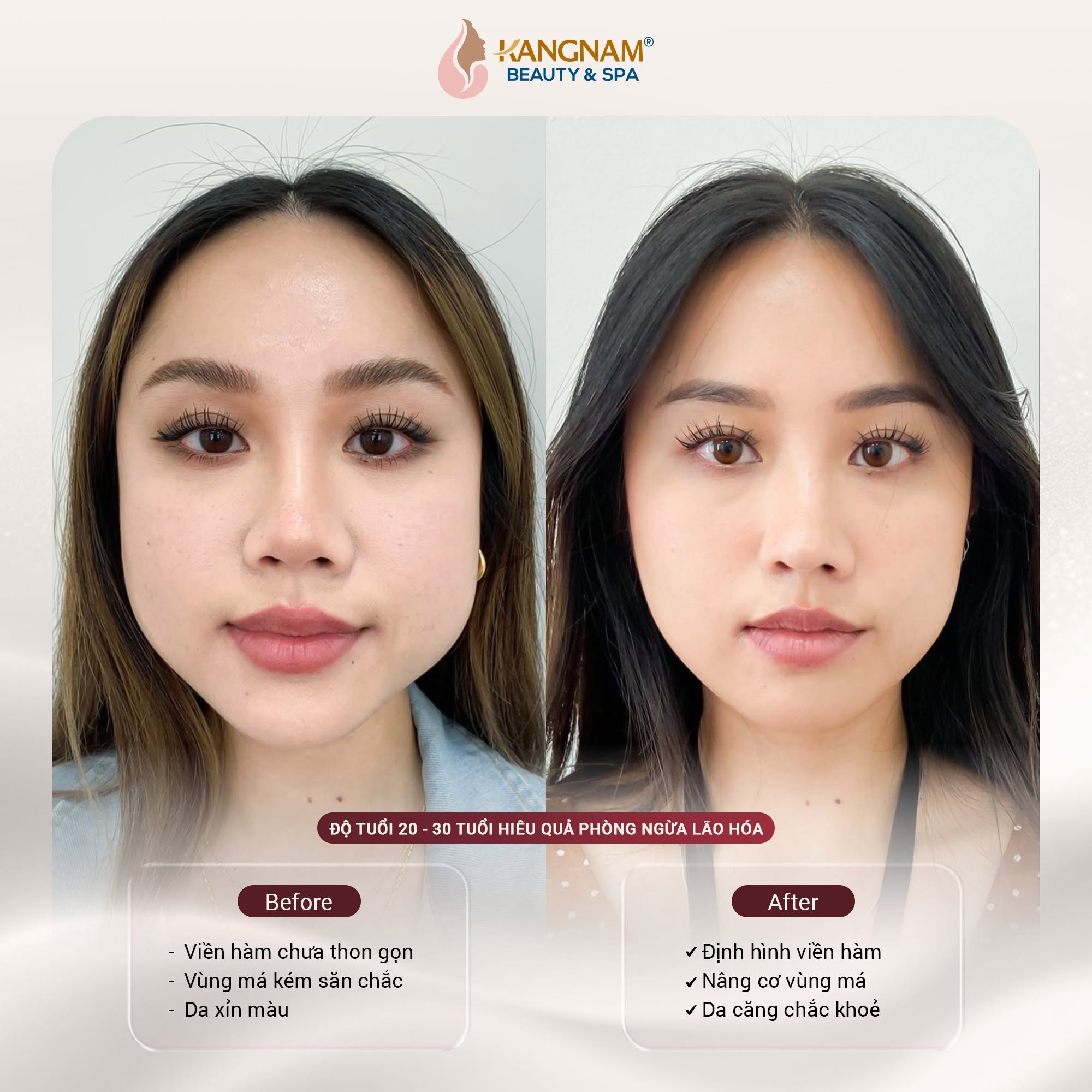Hình ảnh trước và sau cho thấy sự thay đổi ở đường viền hàm, vùng má và độ săn chắc của da sau trẻ hóa. Kết quả có thể khác nhau tùy từng trường hợp.