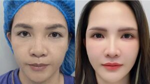 Ảnh trước sau cắt mí thật hay chỉnh sửa? Cách phân biệt