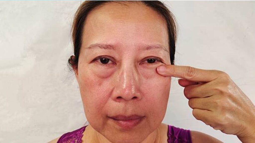 Lấy bọng mỡ mí dưới qua kết mạc có cần chọn kỹ cơ sở?