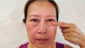 Lấy bọng mỡ mí dưới qua kết mạc có cần chọn kỹ cơ sở?