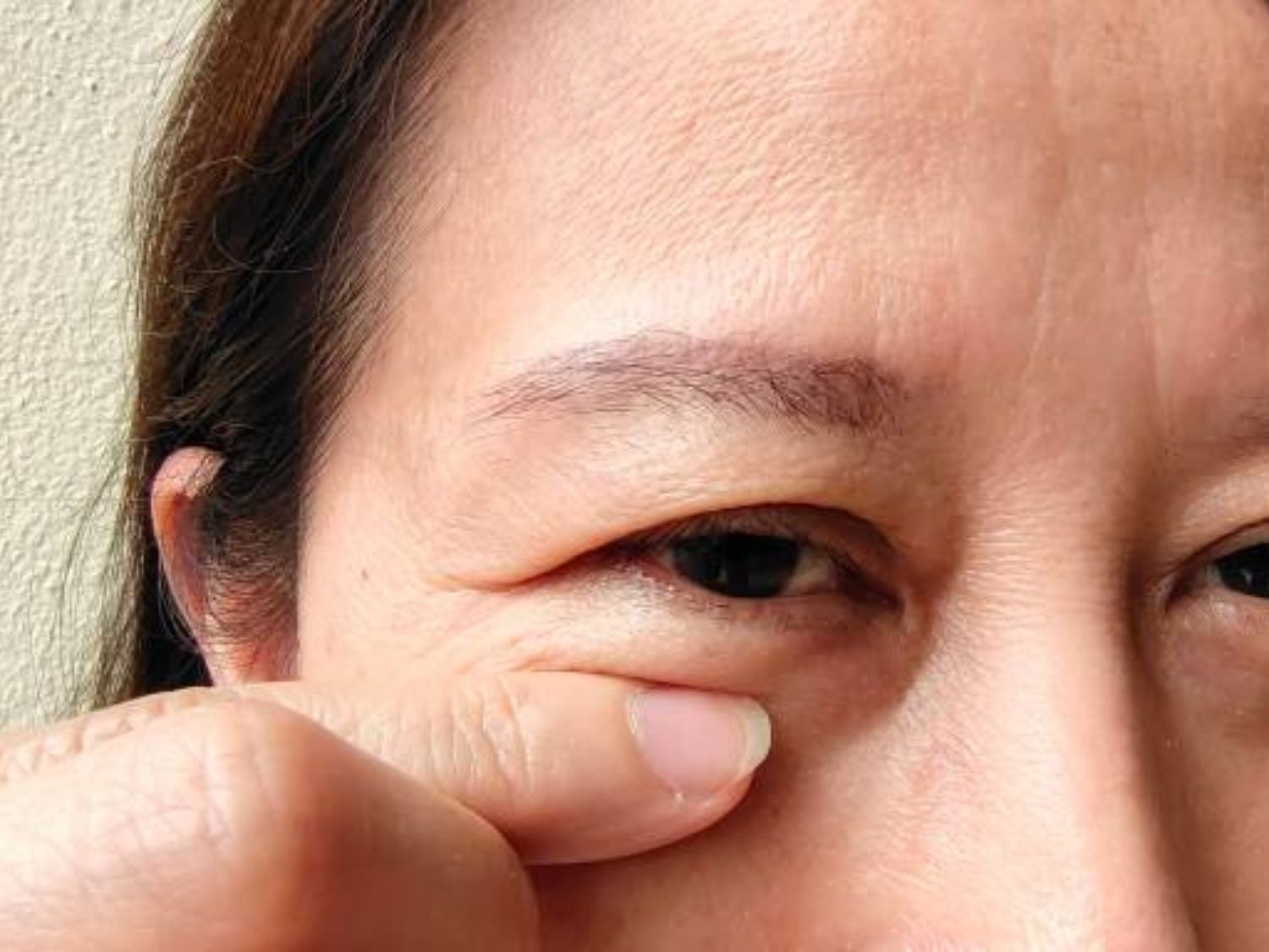 Người có mỡ mí dưới tích tụ nhiều