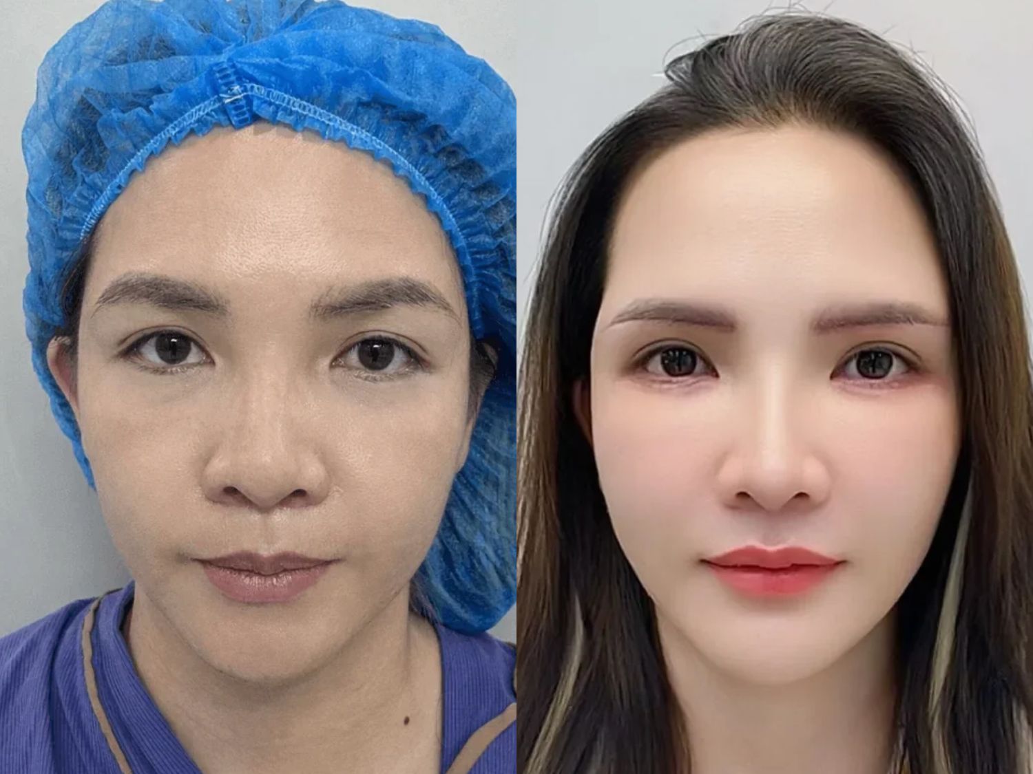 Khách hàng Ngọc Vân gặp tình trạng sụp mí do cung mày sa trễ và sau khi cắt mí, mí đều đẹp tự nhiên