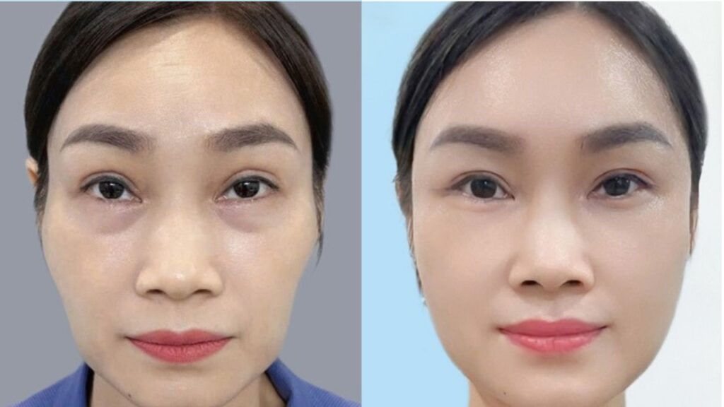 Ảnh trước sau cấy mỡ mặt: Làm sao biết ảnh thật?