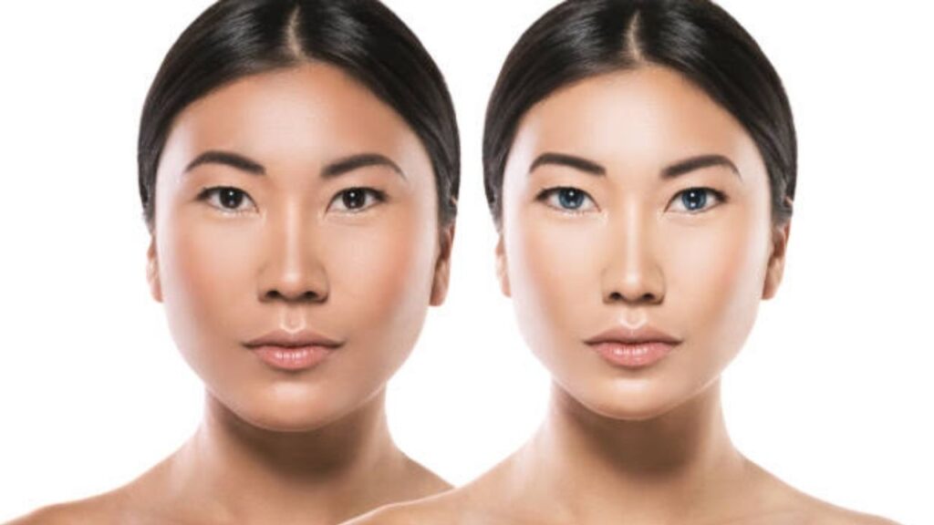 Ảnh trước sau tiêm botox trên mạng có tin được không?