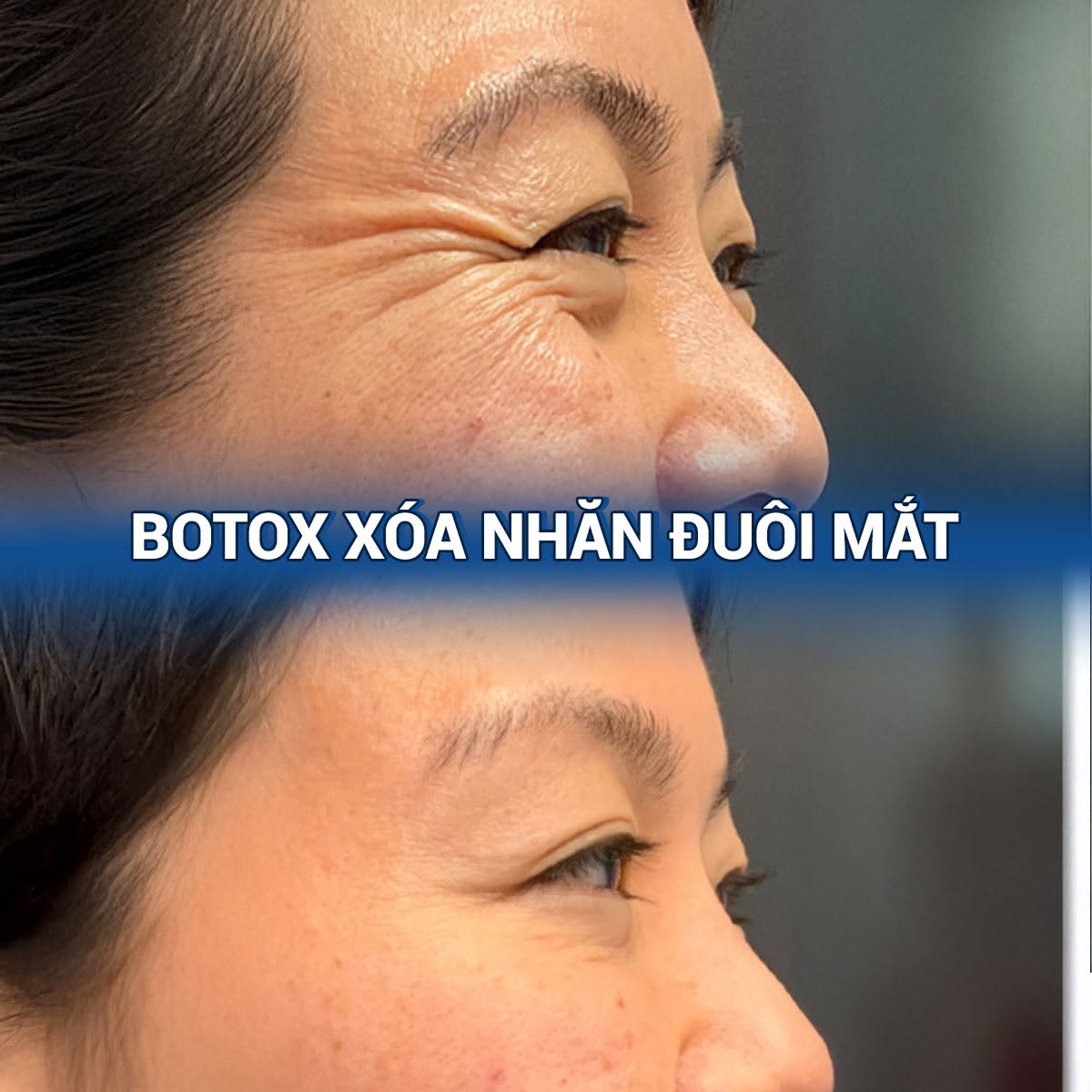 Tiêm botox đuôi mắt giúp vùng mắt tươi trẻ, giảm nếp nhăn