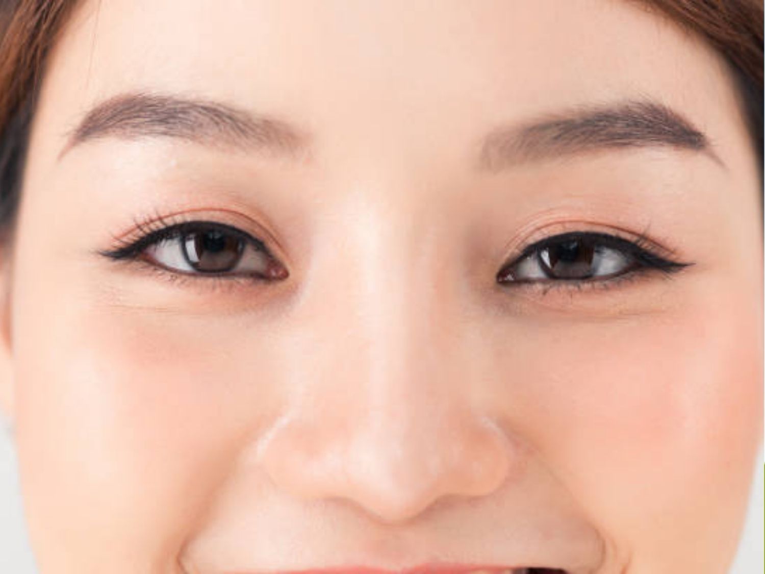 Mí mắt bị sụp do tiêm botox giá rẻ, không đảm bảo