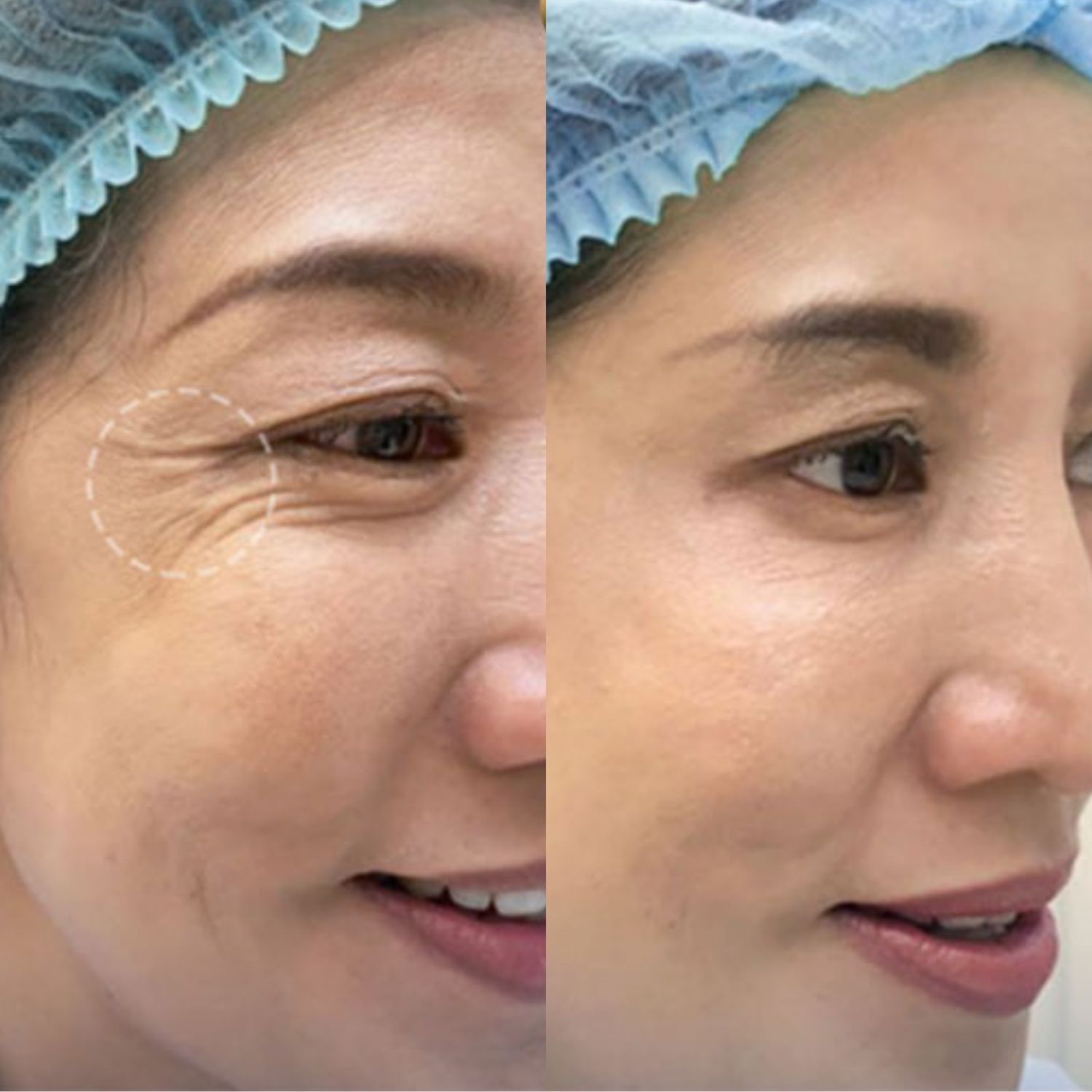 Ảnh trước và sau khi tiêm botox xóa nhăn đuôi mắt, khách hàng duy trì vẻ đẹp lâu dài