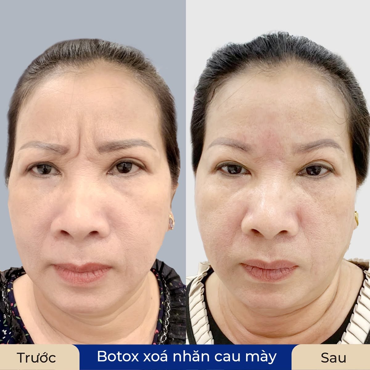 So sánh vùng cau mày trước và sau tiêm Botox nhằm cải thiện nếp nhăn khi biểu cảm.