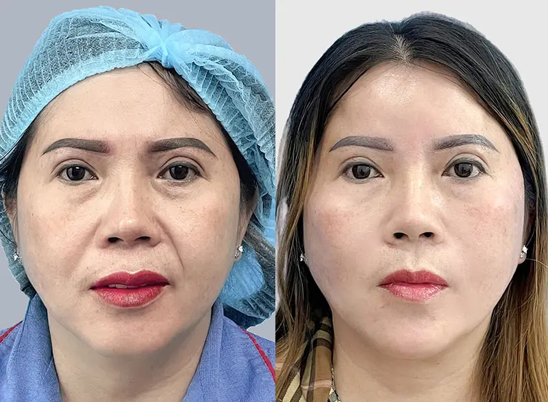 Hình ảnh trước và sau căng da mặt cho thấy sự thay đổi ở vùng má, đường viền hàm và tình trạng da chùng. Kết quả thực tế có thể khác nhau tùy từng trường hợp.