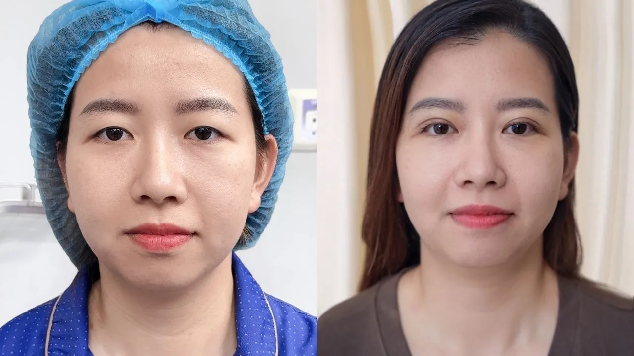 Khách hàng Hồng Thủy trươc - sau khi cắt mí tại Kangnam