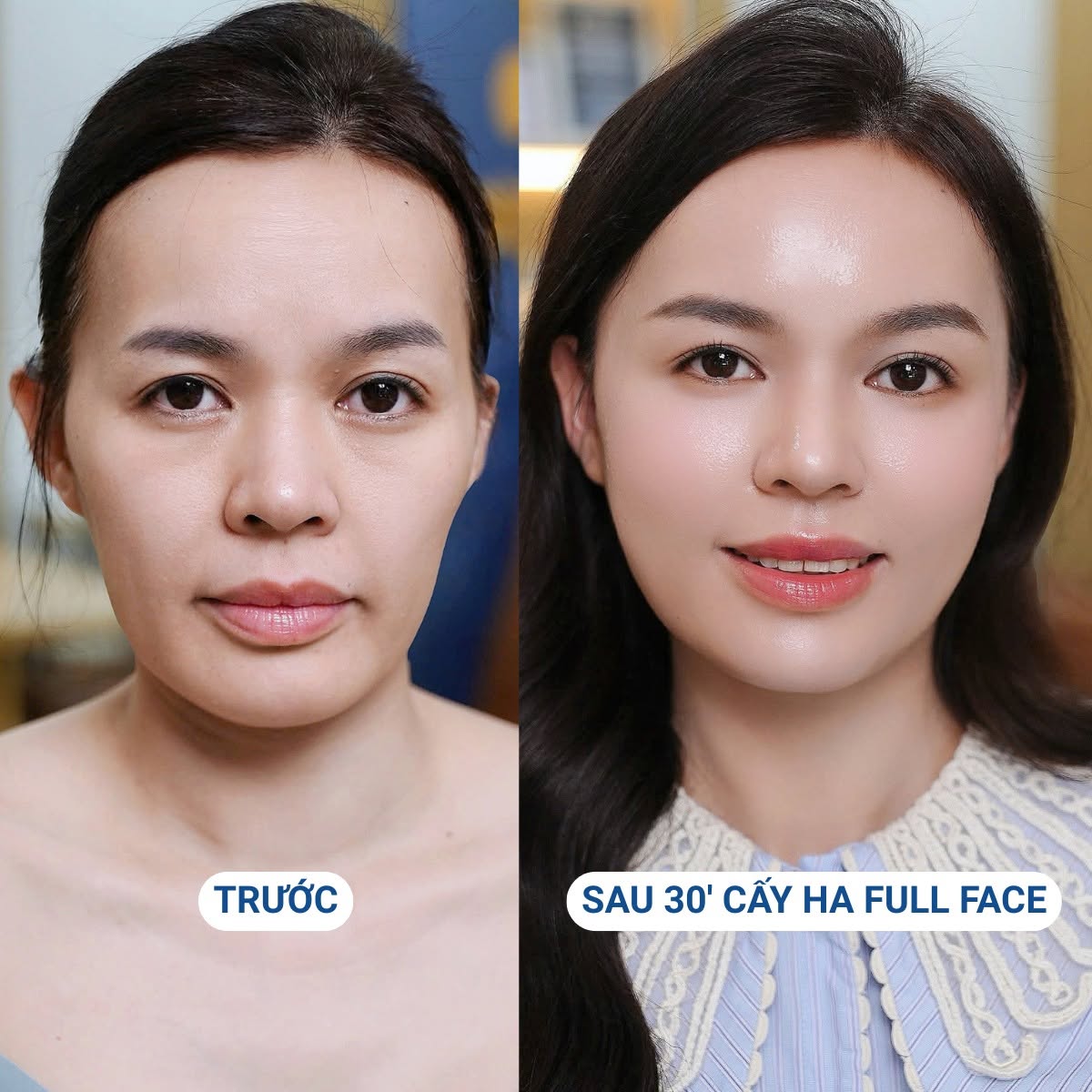 Cấy Ha giúp gương mặt đầy đặn, tươi trẻ