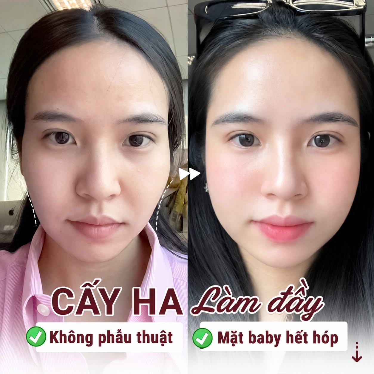 Khách hàng sau cấy HA tại Kangnam có sự cải thiện về độ đầy đặn của gương mặt, giảm cảm giác lõm hóp, mang lại diện mạo mềm mại và trẻ trung hơn.
