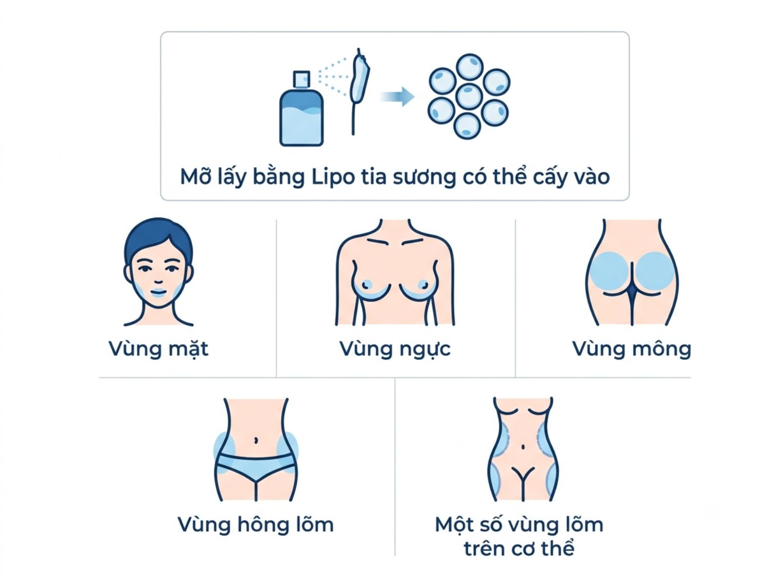 Ứng dụng cấy mỡ tự thân Lipo tia sương cho các vùng trên cơ thể.
