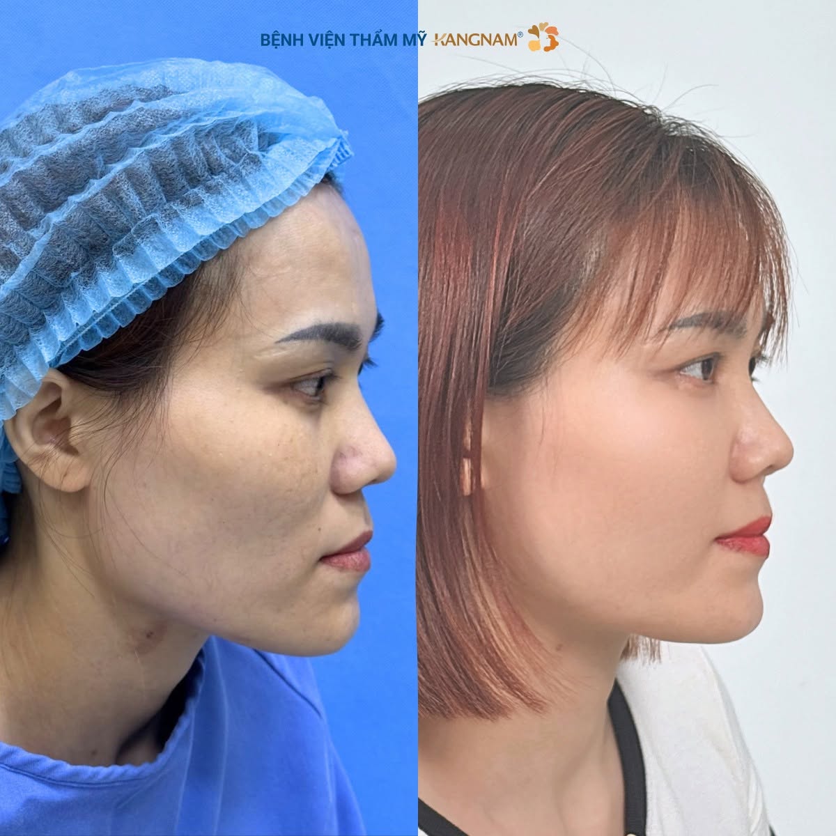 Hình ảnh trước và sau cấy mỡ mặt tự thân tại Kangnam Sài Gòn cho thấy vùng má có sự thay đổi về thể tích, giúp đường nét khuôn mặt trông đầy đặn và mềm mại hơn. Kết quả thực tế có thể khác nhau tùy cơ địa và tình trạng mô của từng khách hàng.