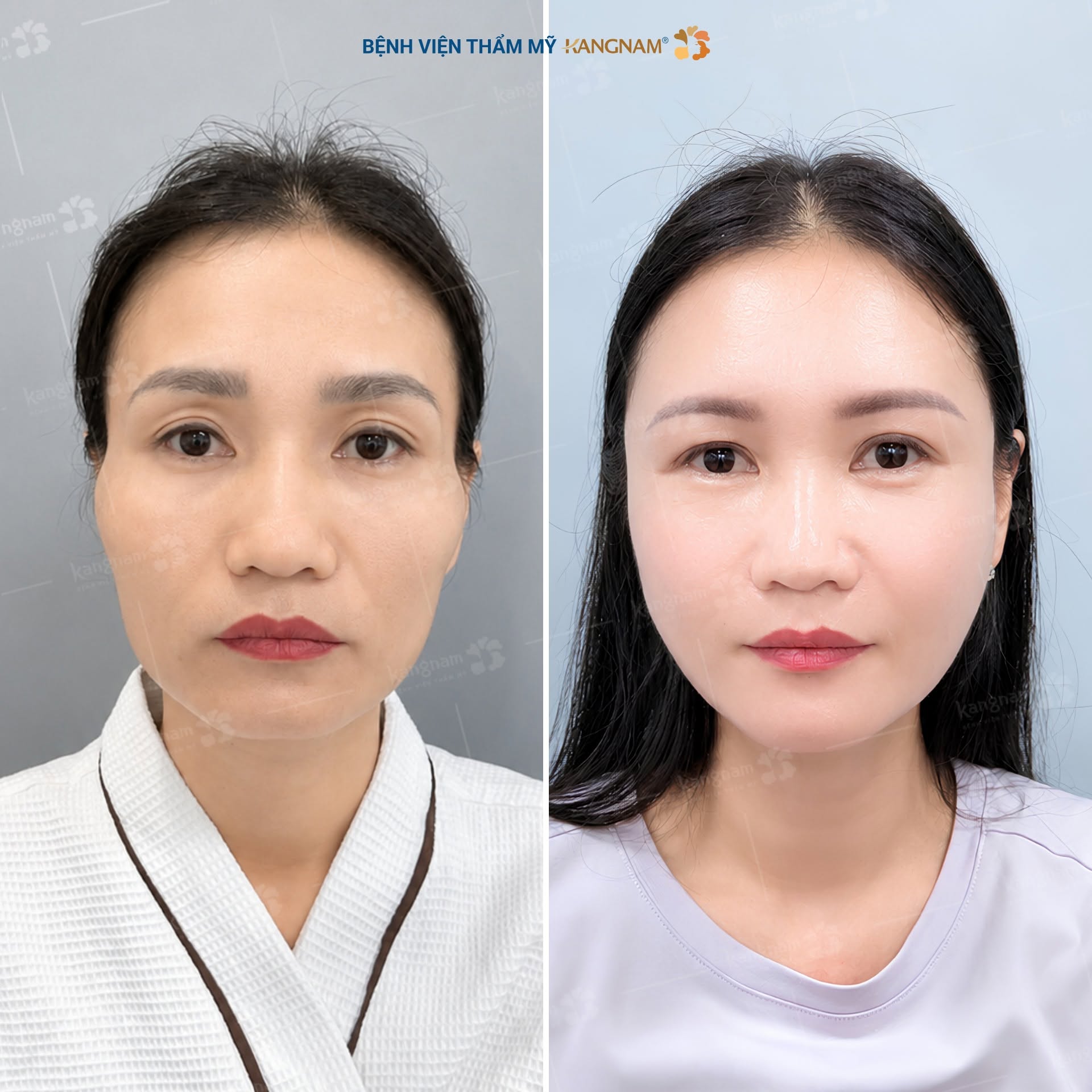 Cần lựa chọn địa chỉ cấy mỡ uy tín