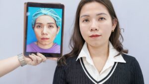 Cấy mỡ lần 2 giá bao nhiêu? Có được miễn phí cấy bổ sung không?