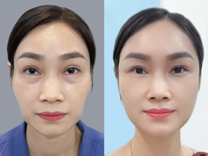 ảnh trước - sau của khách cấy mỡ mặt tự thân tại Kangnam